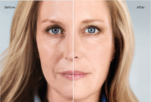 Sculptra before and after 25 months