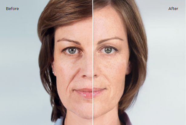 Sculptra before and after 25 months