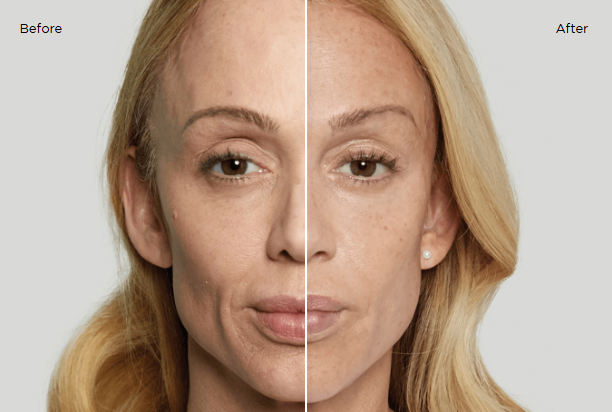 Sculptra before and after 6 months
